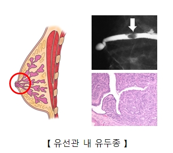 유방의 유선관내 유두종