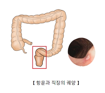 항문 및 직장의 궤양