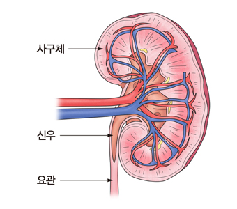 신장이형성증