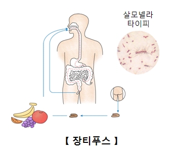 장티푸스