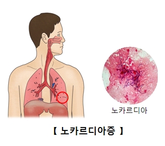 노카르디아증