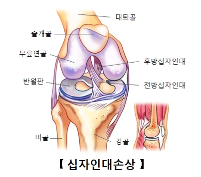 십자 인대 손상