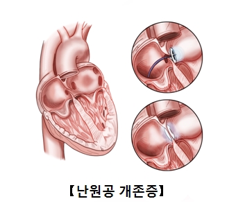 난원공 개존증