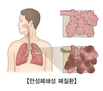 만성 폐쇄성 폐질환