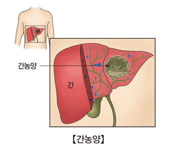 간농양