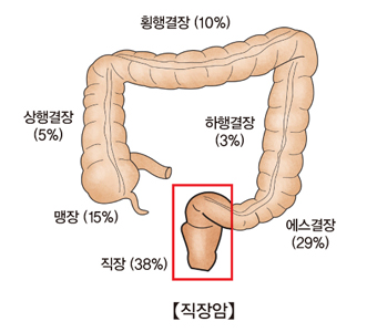 직장암