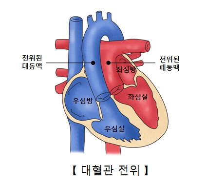 대혈관 전위