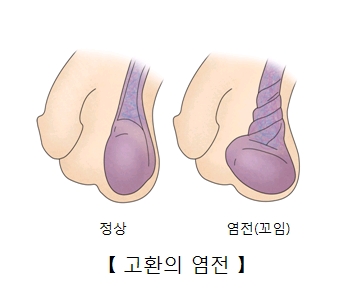 고환의 염전