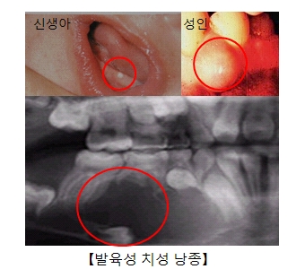 발육성 치성 낭종