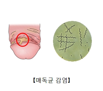 잠복 매독