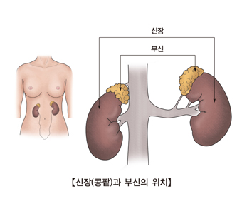 부신종양