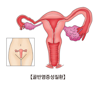 골반염증성 질환