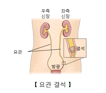 요관결석