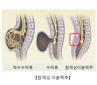 잠재성이분척추