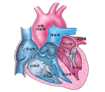 불안정형 협심증