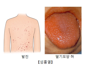 성홍열