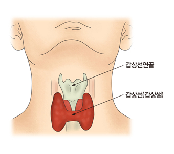 산후갑상선염