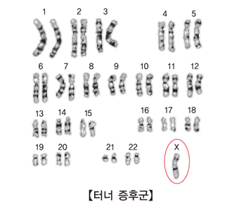 터너 증후군