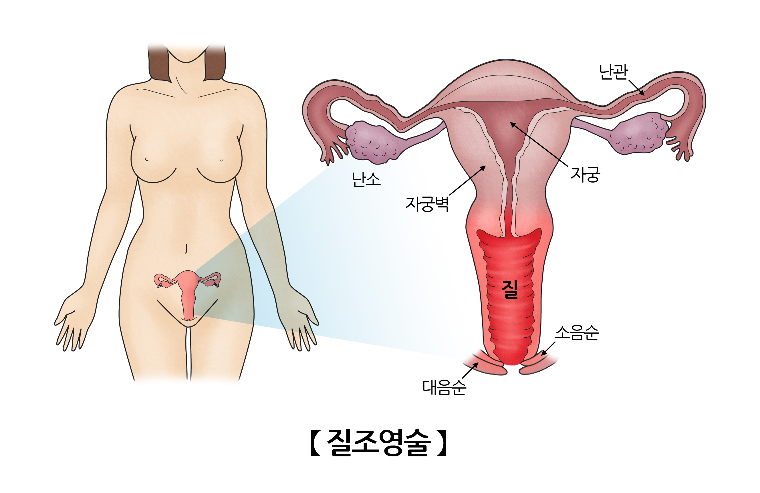 질 조영술