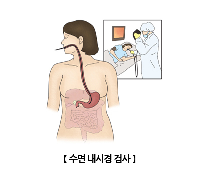 수면내시경