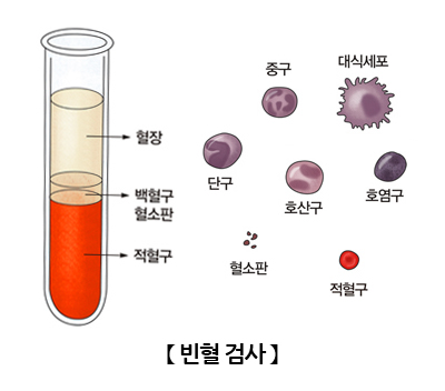 빈혈검사