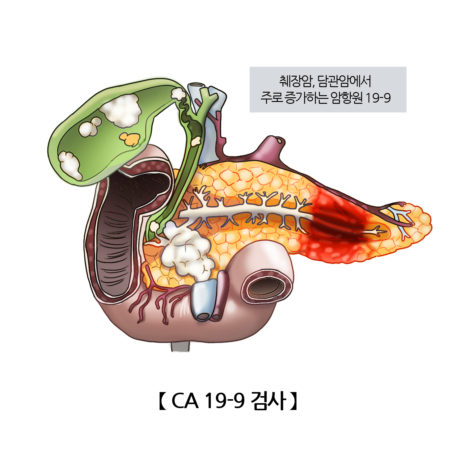 췌장염